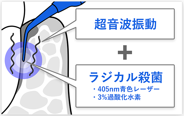 従来の治療で取り残しやすい部位